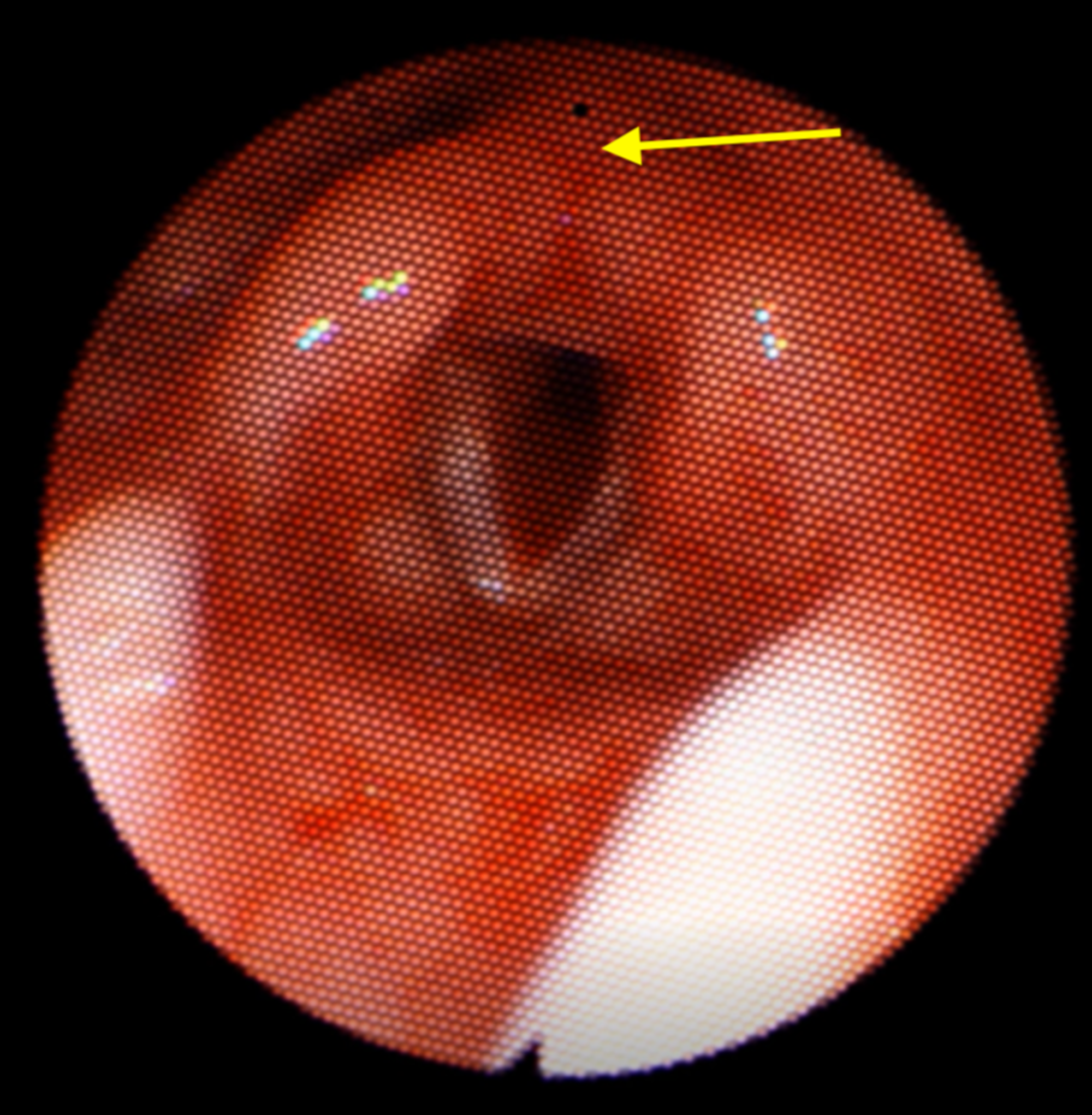 Cureus Paradoxical Vocal Cord Motion Presaging Bilateral Vocal Cord Paresis In An Infant 5903