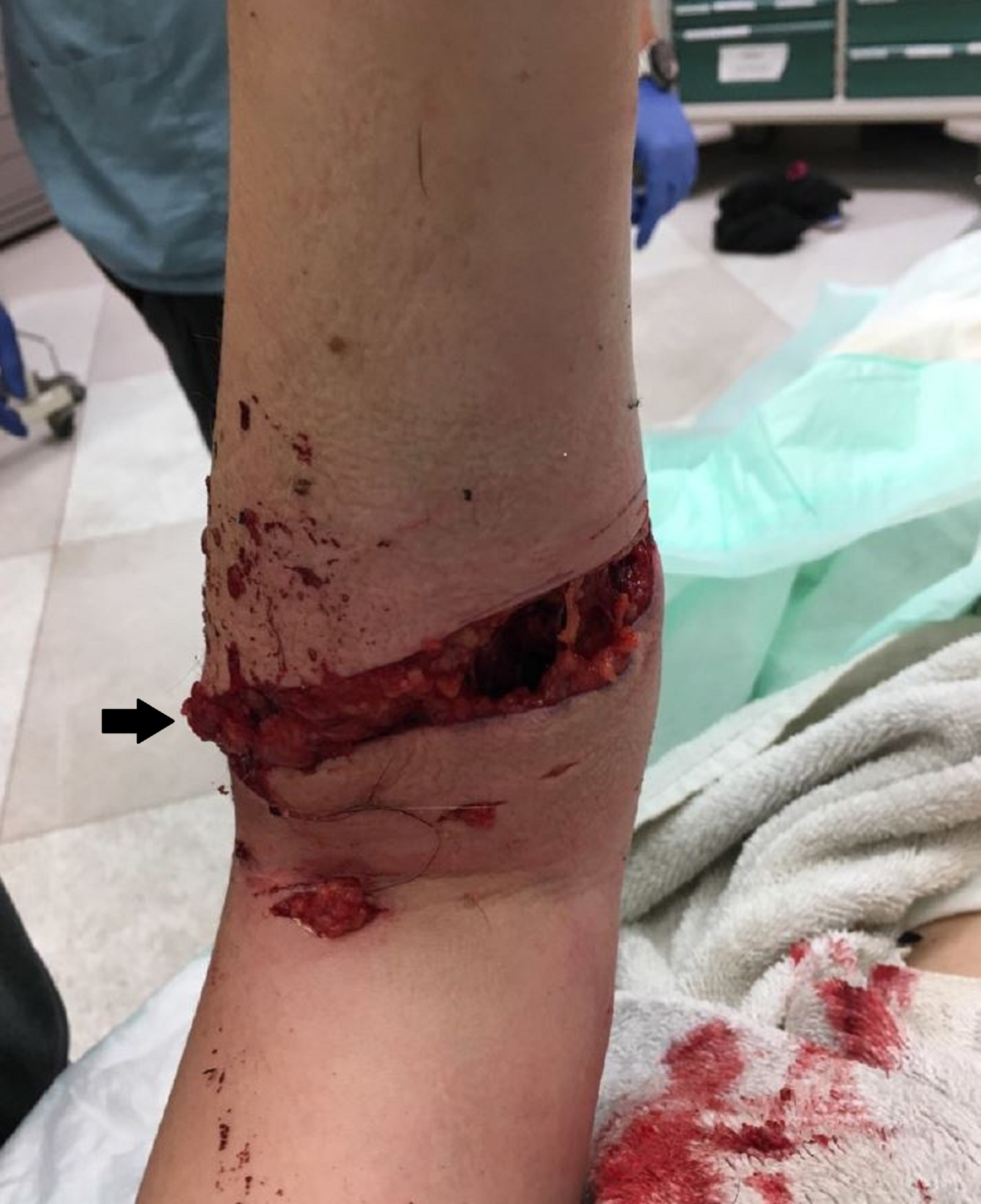 Cureus | Complex Wound Closure Following Mysterious and Vicious Animal  Attack | Article