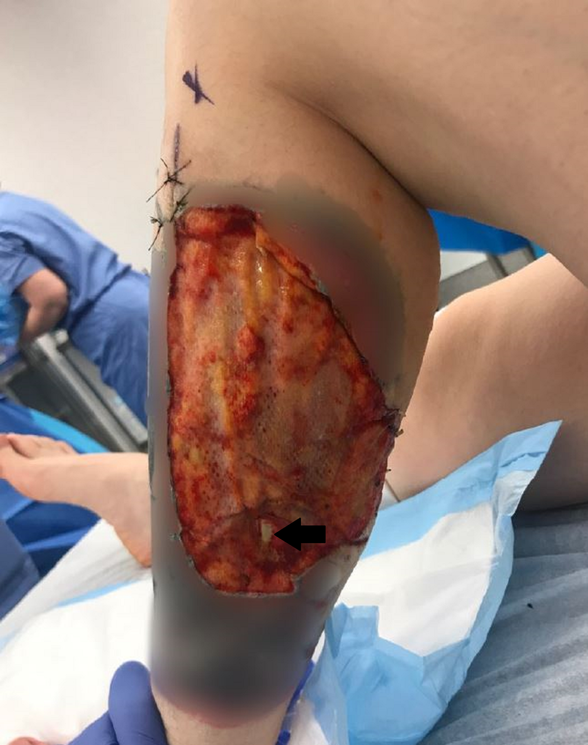 Cureus | Complex Wound Closure Following Mysterious and Vicious Animal  Attack | Article
