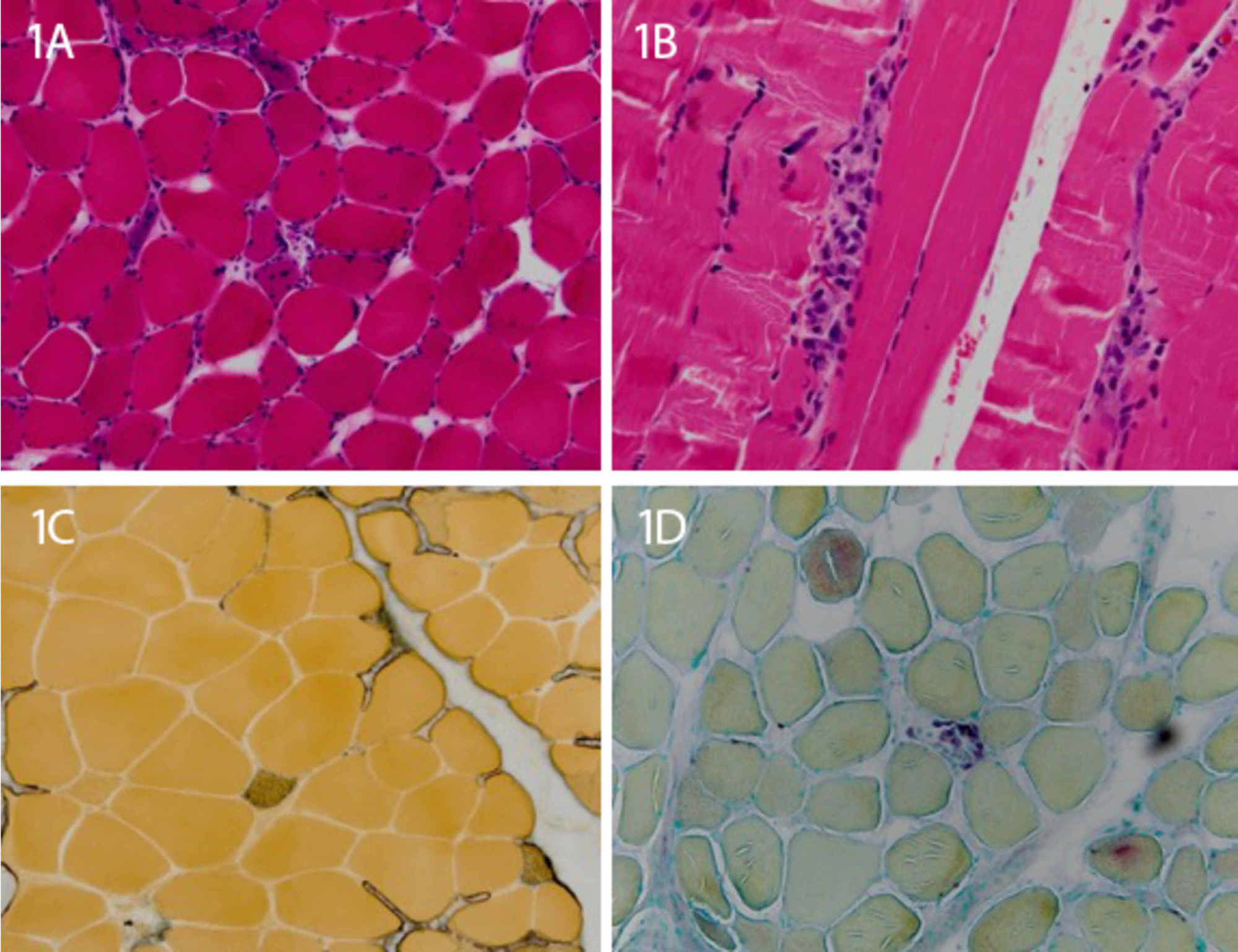 Cureus Autoantibody Negative Immune Mediated Necrotizing Myopathy Responds To Early And Aggressive Treatment A Case Report