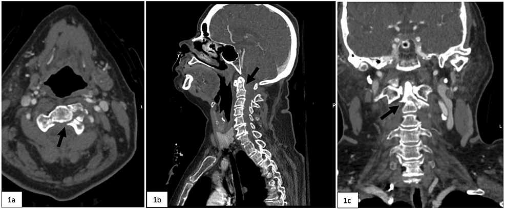 CT-images-demonstrating-the-type-III-dens-fracture-indicated-by-the-black-arrow-on-(a)-axial-view,-(b)-sagittal-view,-and-(c)-coronal-view