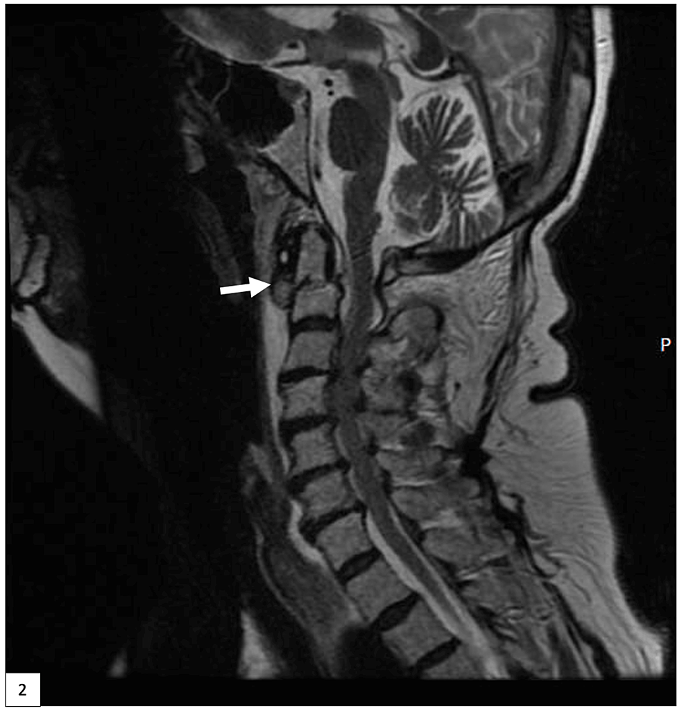 T2-sagittal-MRI-of-the-cervical-spine-demonstrating-the-type-III-dens-fracture-indicated-by-the-white-arrow