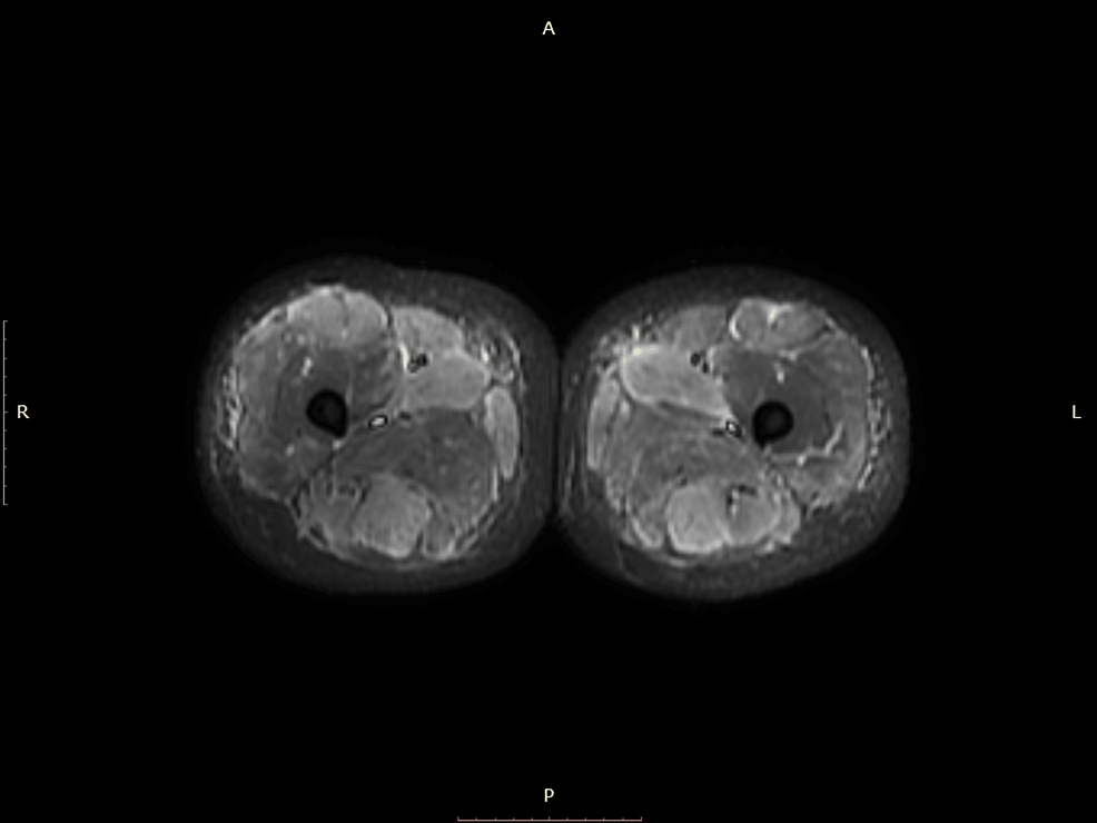 MRI-axial-STIR-image-of-bilateral-lower-extremities-showing-muscle-inflammation