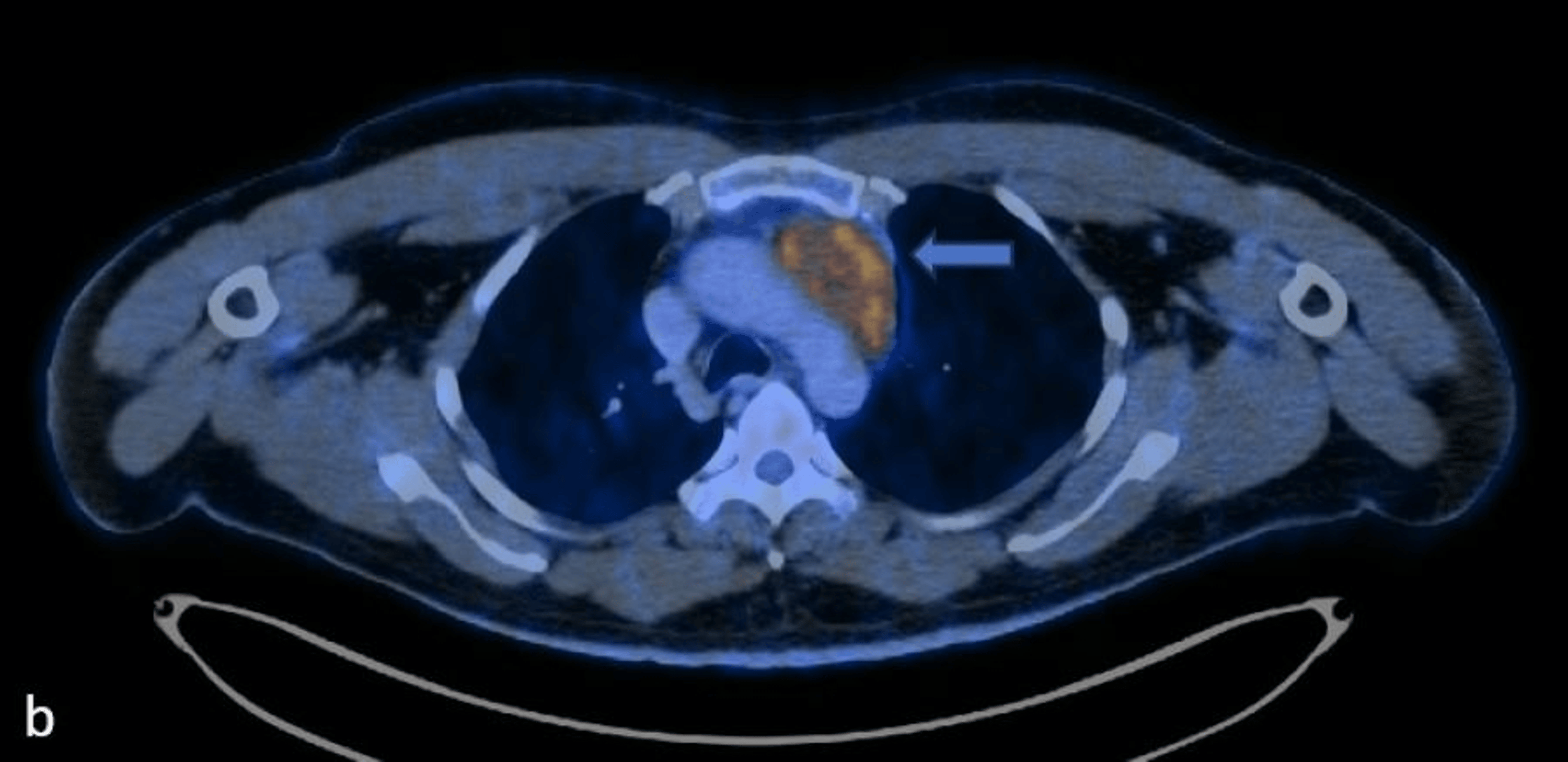 Thymic Lymphoepithelial Carcinoma A Rare Aggressive Mediastinal Mass