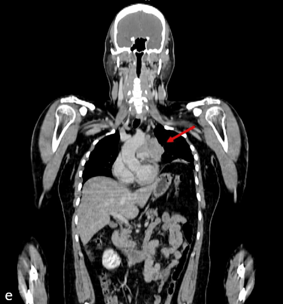 Thymic Lymphoepithelial Carcinoma A Rare Aggressive Mediastinal Mass