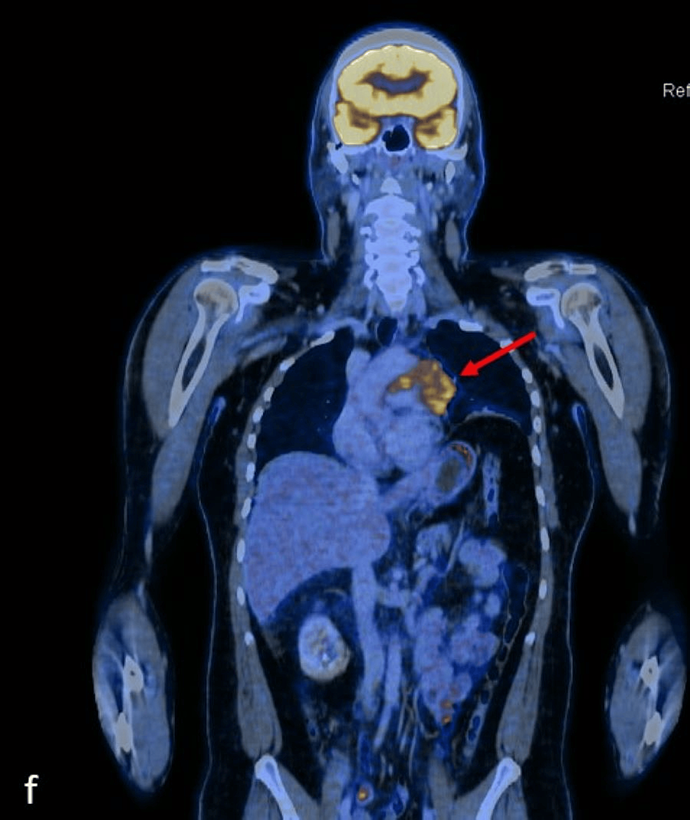 Thymic Lymphoepithelial Carcinoma A Rare Aggressive Mediastinal Mass