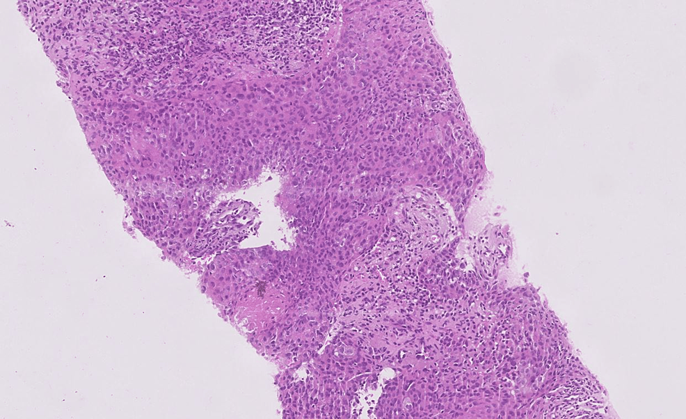 Thymic Lymphoepithelial Carcinoma A Rare Aggressive Mediastinal Mass