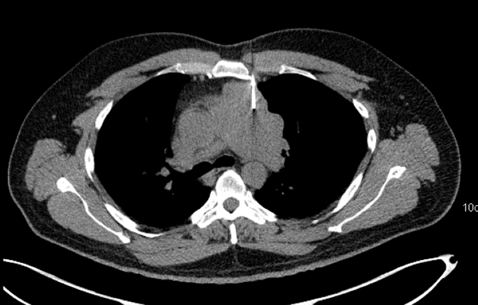 Thymic Lymphoepithelial Carcinoma A Rare Aggressive Mediastinal Mass
