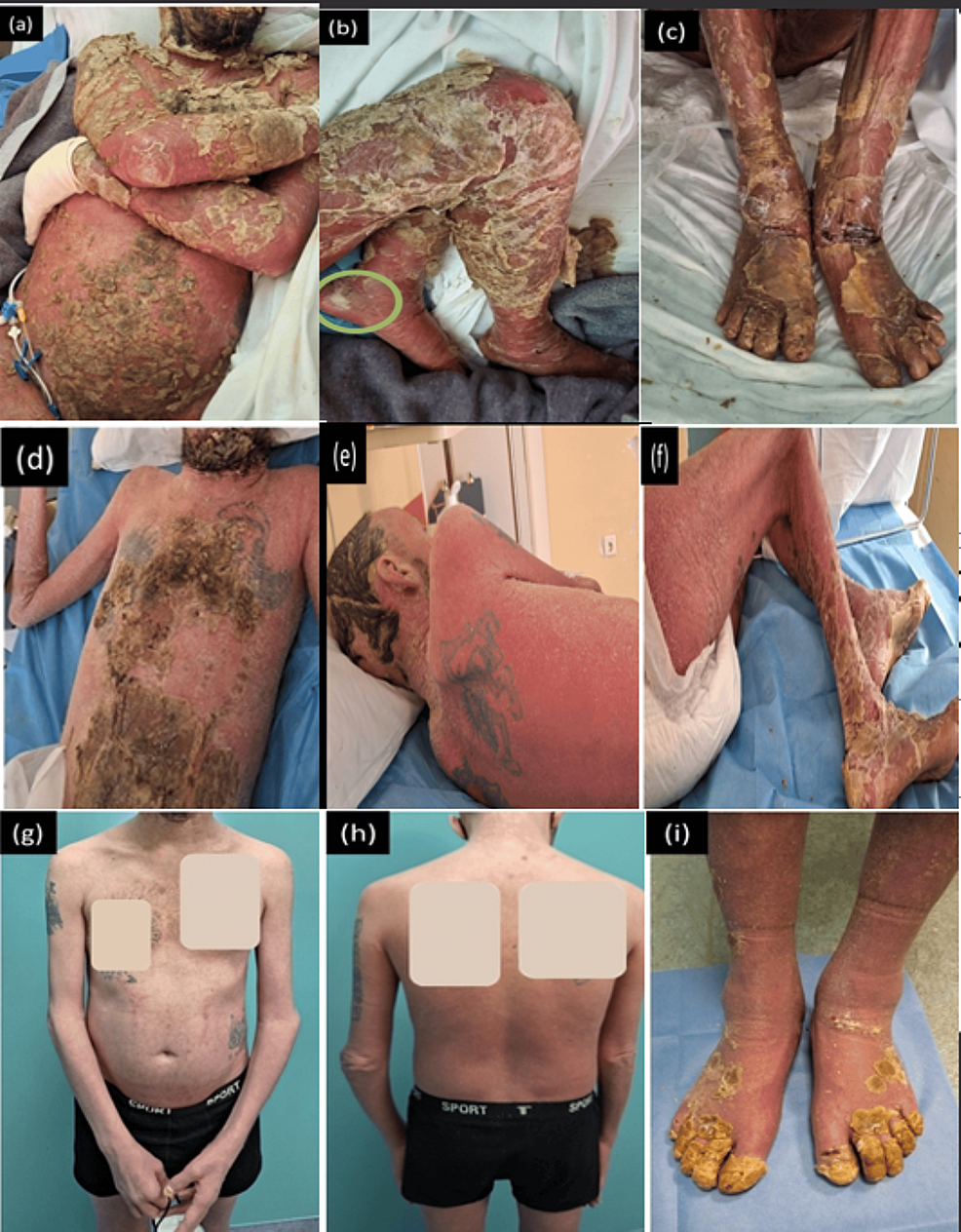 glutathione psoriasis reddit Effective Management of Life-Threatening Generalized Pustular Psoriasis  Flare With Spesolimab