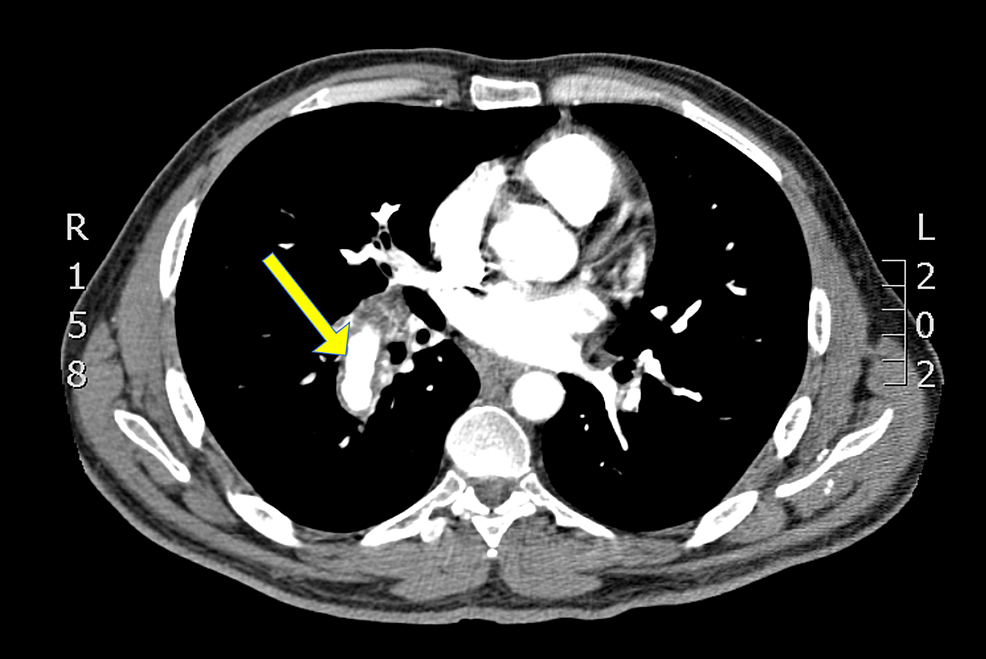 cureus-castleman-s-disease-with-pulmonary-artery-aneurysm-a-rare