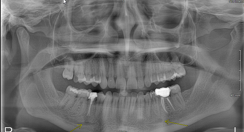 Cureus | Melody Valve Endocarditis Due to Rothia dentocariosa: A ...