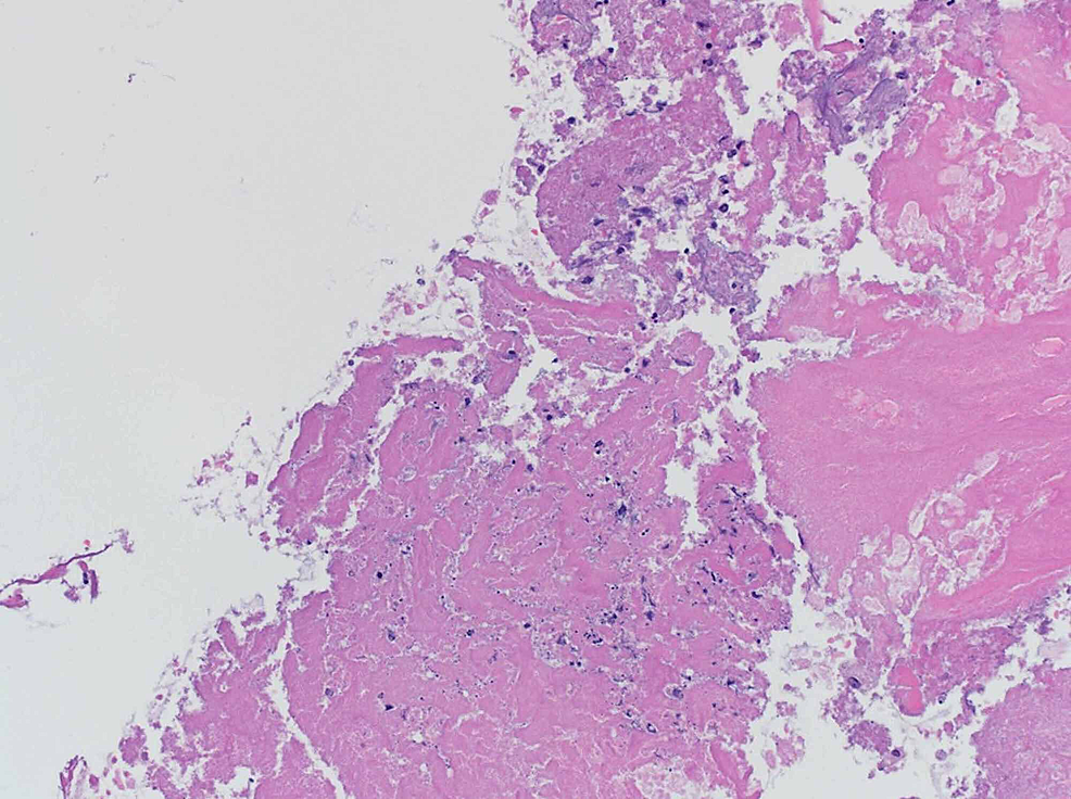 Cureus | Melody Valve Endocarditis Due to Rothia dentocariosa: A ...