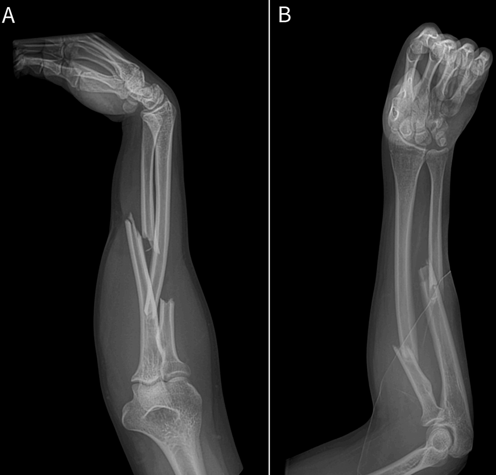 Acute Compression of the Anterior Interosseous Nerve After a Proximal