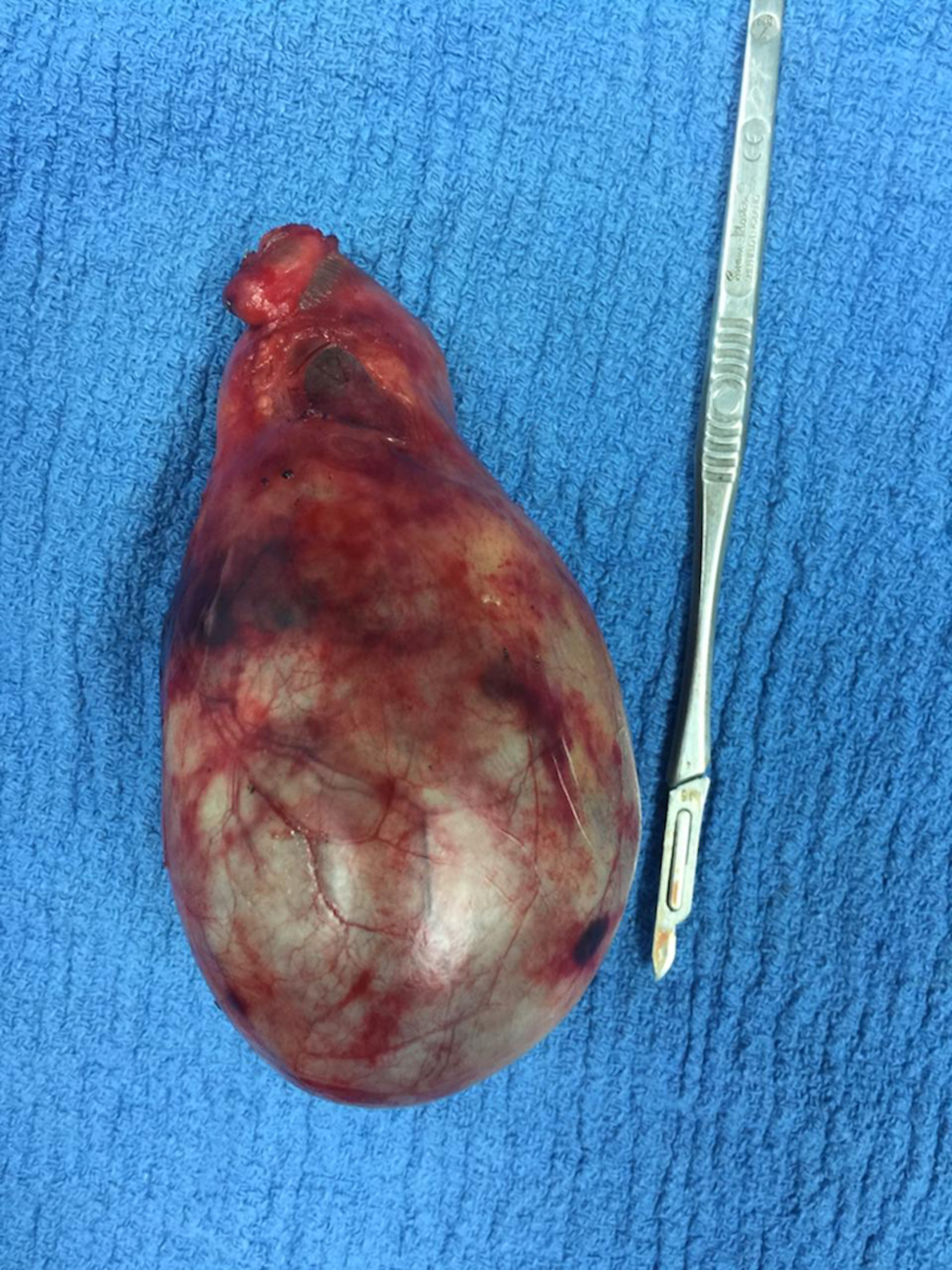 Cureus A Giant Gallstone The Largest Gallstone Removed Laparoscopically In The World