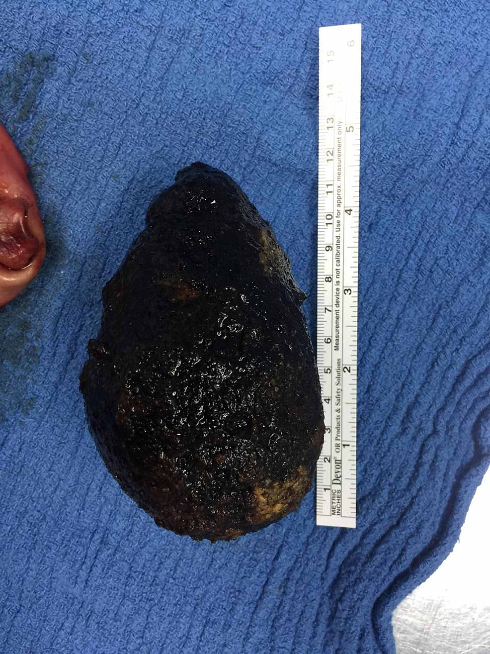 cureus-a-giant-gallstone-the-largest-gallstone-removed