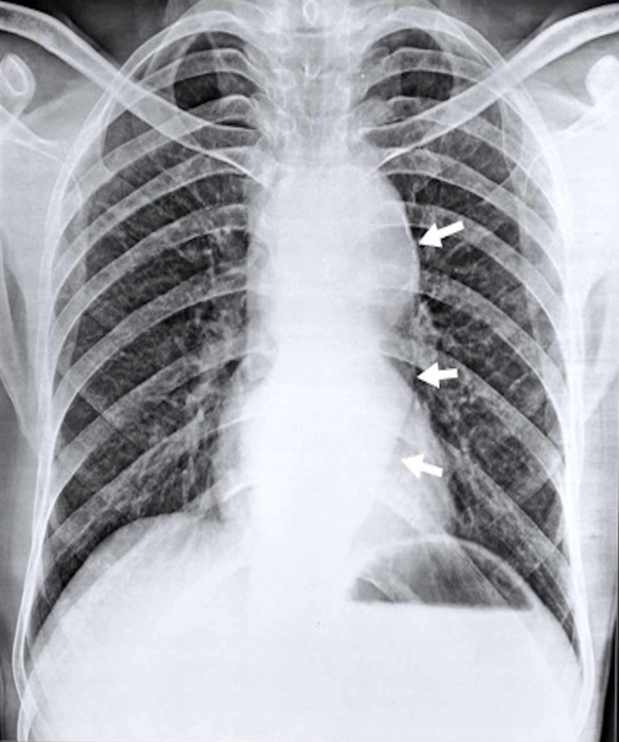 Aortic Aneurysm Chest X Ray
