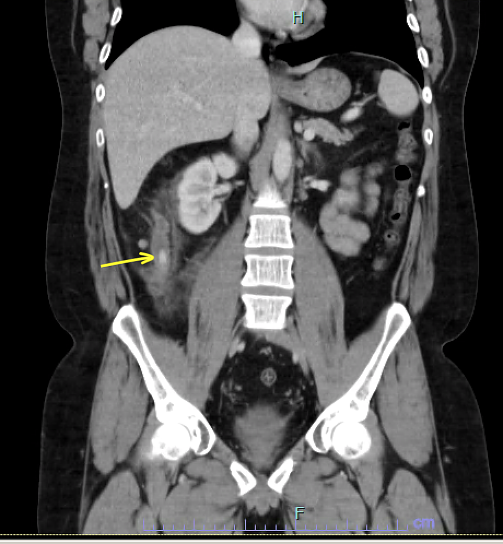 CT-scan-of-the-abdomen-and-pelvis-showing-acute-appendicitis-and-an-11-mm-appendicolith-at-the-base-of-the-appendix