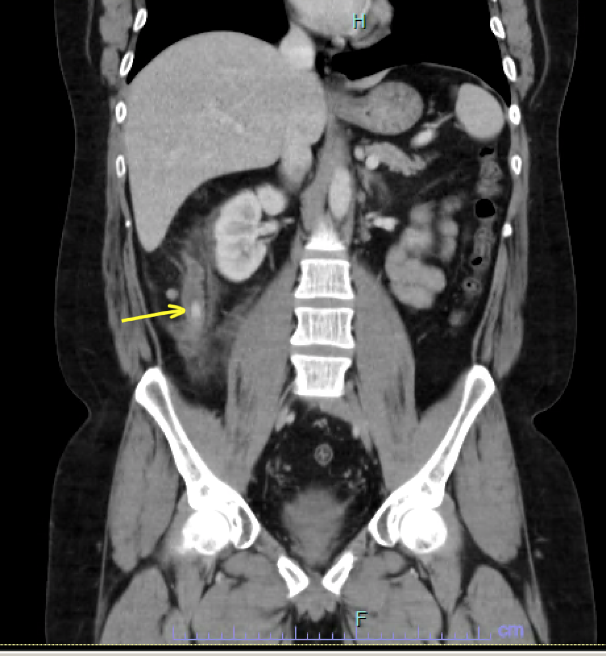 Ct Scan Abdominal Pelvis Showing A Non Complicated Acute Appendicitis ...