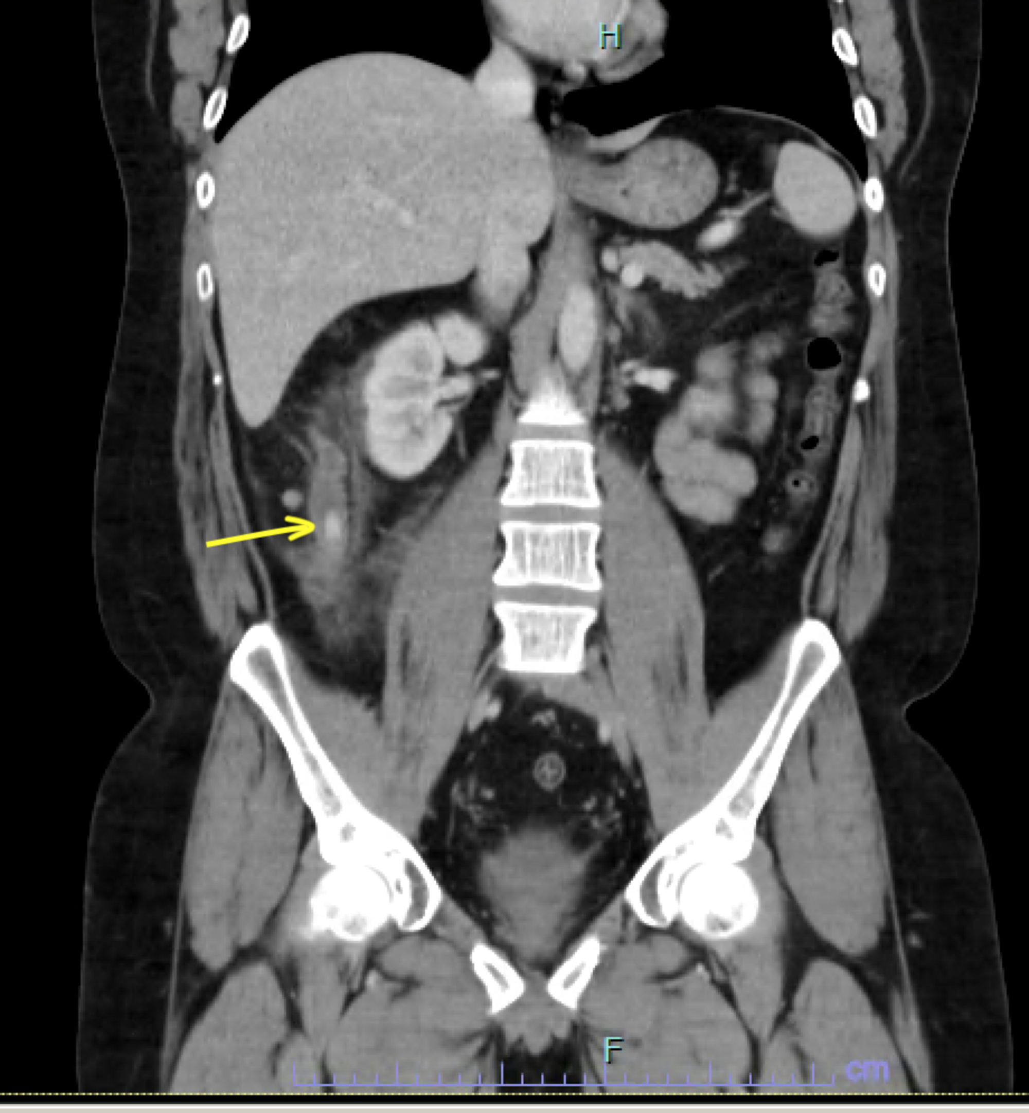 Appendicitis On Ct Scan 6790