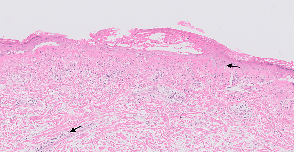 Histopathology-slide-of-the-rash-on-the-upper-back-of-patient-2