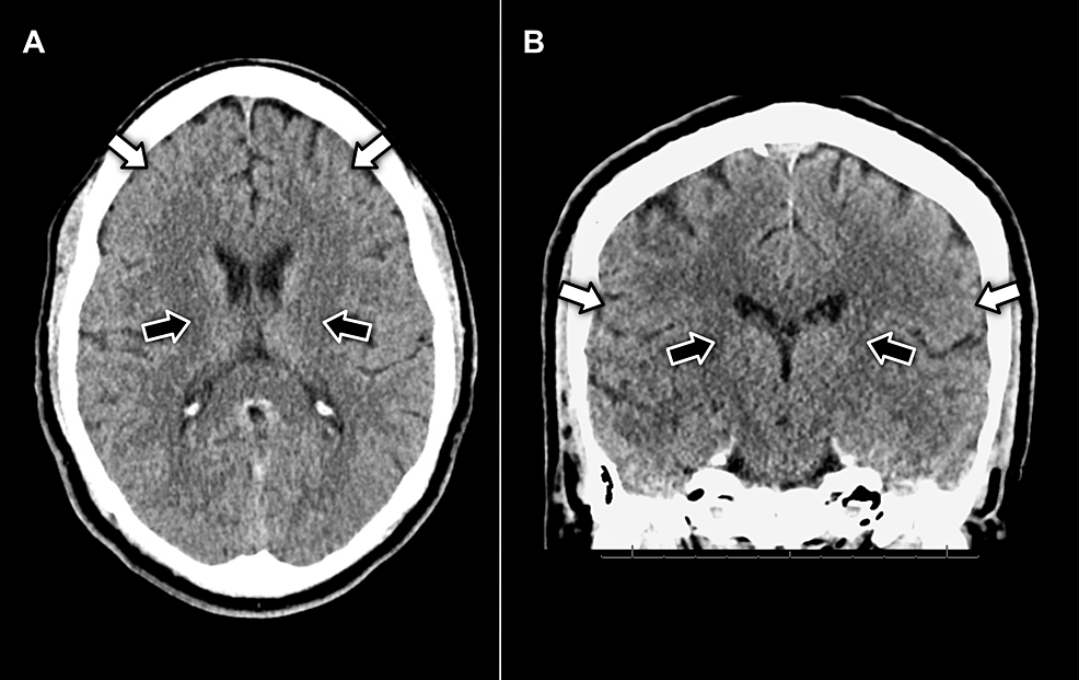 (A)-axial-and-(B)-coronal-view-CT-imaging-of-the-head-without-contrast-displaying-no-evidence-of-pathology-in-the-facial-motor-cortex-(white-arrows)-or-neuron-pathways-in-the-internal-capsule-(black-arrows)