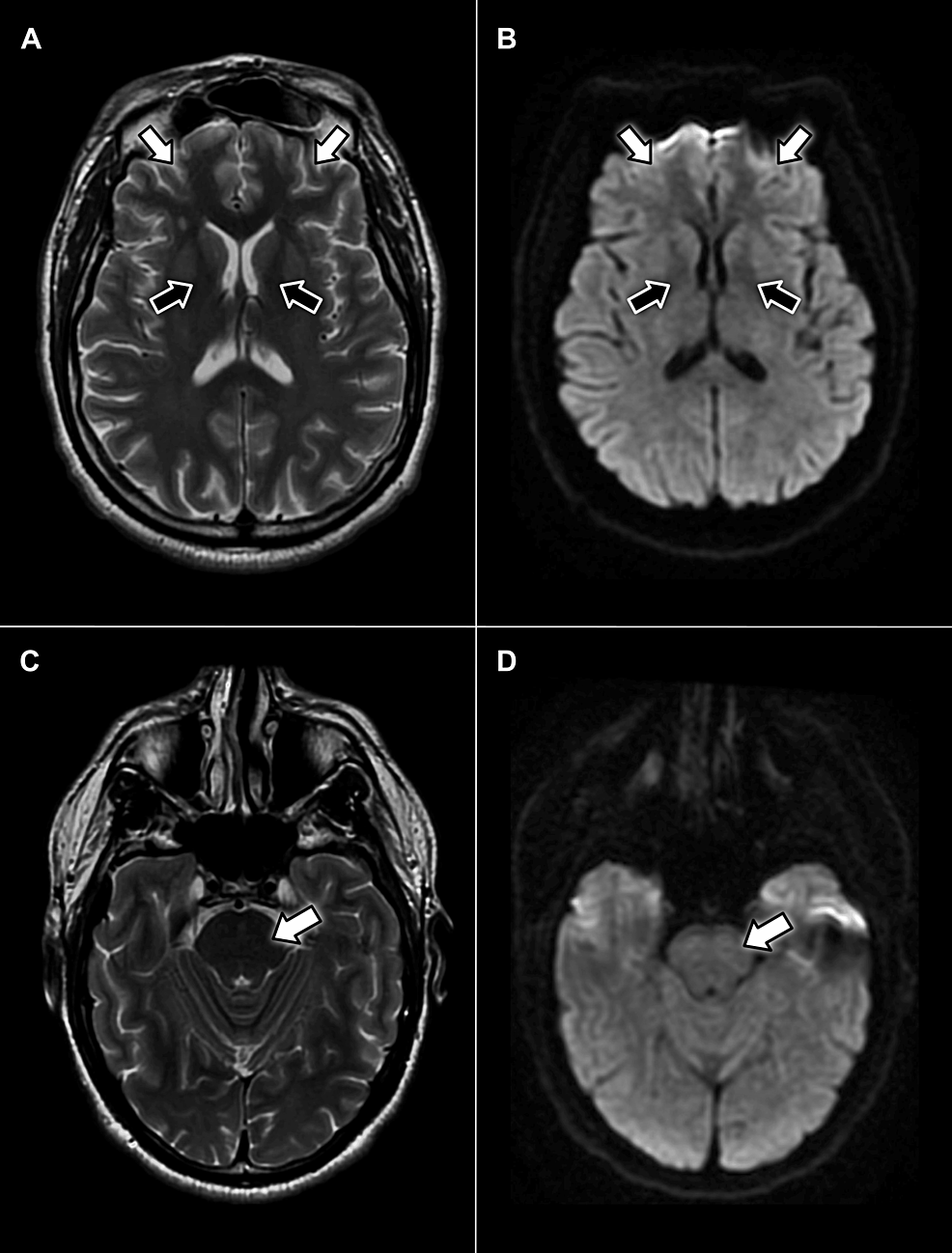 Axial-MRI-scans-without-contrast-displaying-no-evidence-of-pathology-in-the-facial-motor-cortex-(white-arrows)-or-neuron-pathways-in-the-internal-capsule-(black-arrows)-on-T2-weighted-(A)-or-diffusion-weighted-(B)-sequences.-Additionally,-no-hyperintense-signals-appear-within-the-pons-on-T2-weighted-(C)-or-diffusion-weighted-(D)-sequences