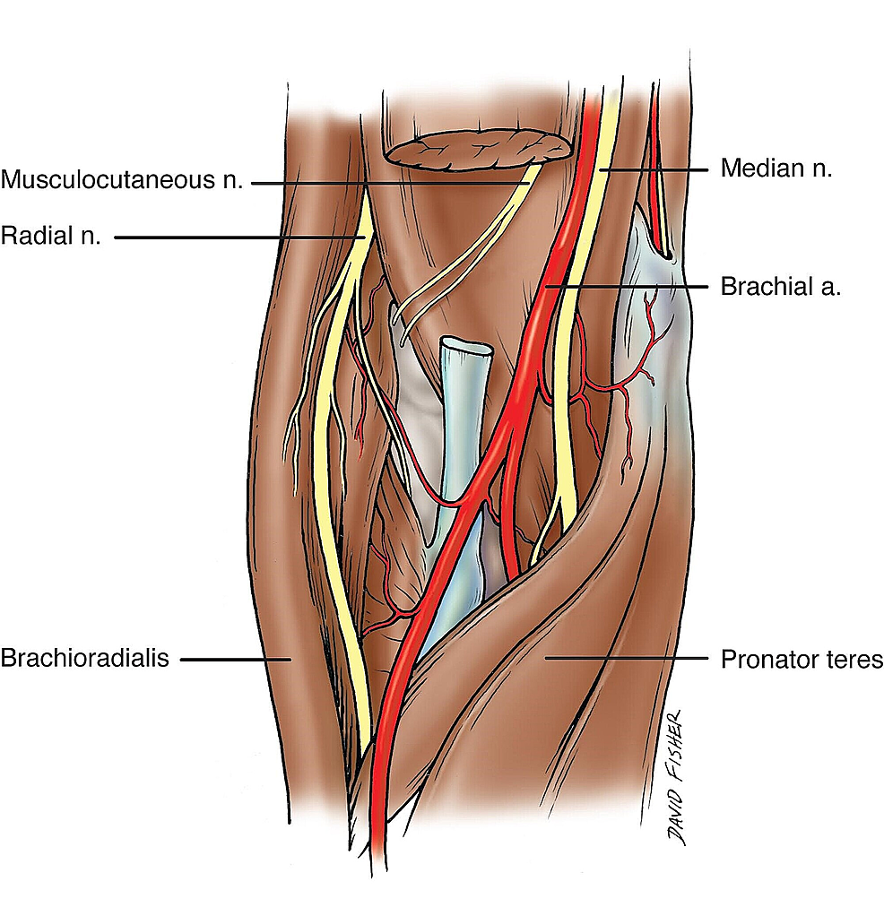 Unusual course of the median nerve through the forearm. A-Medial