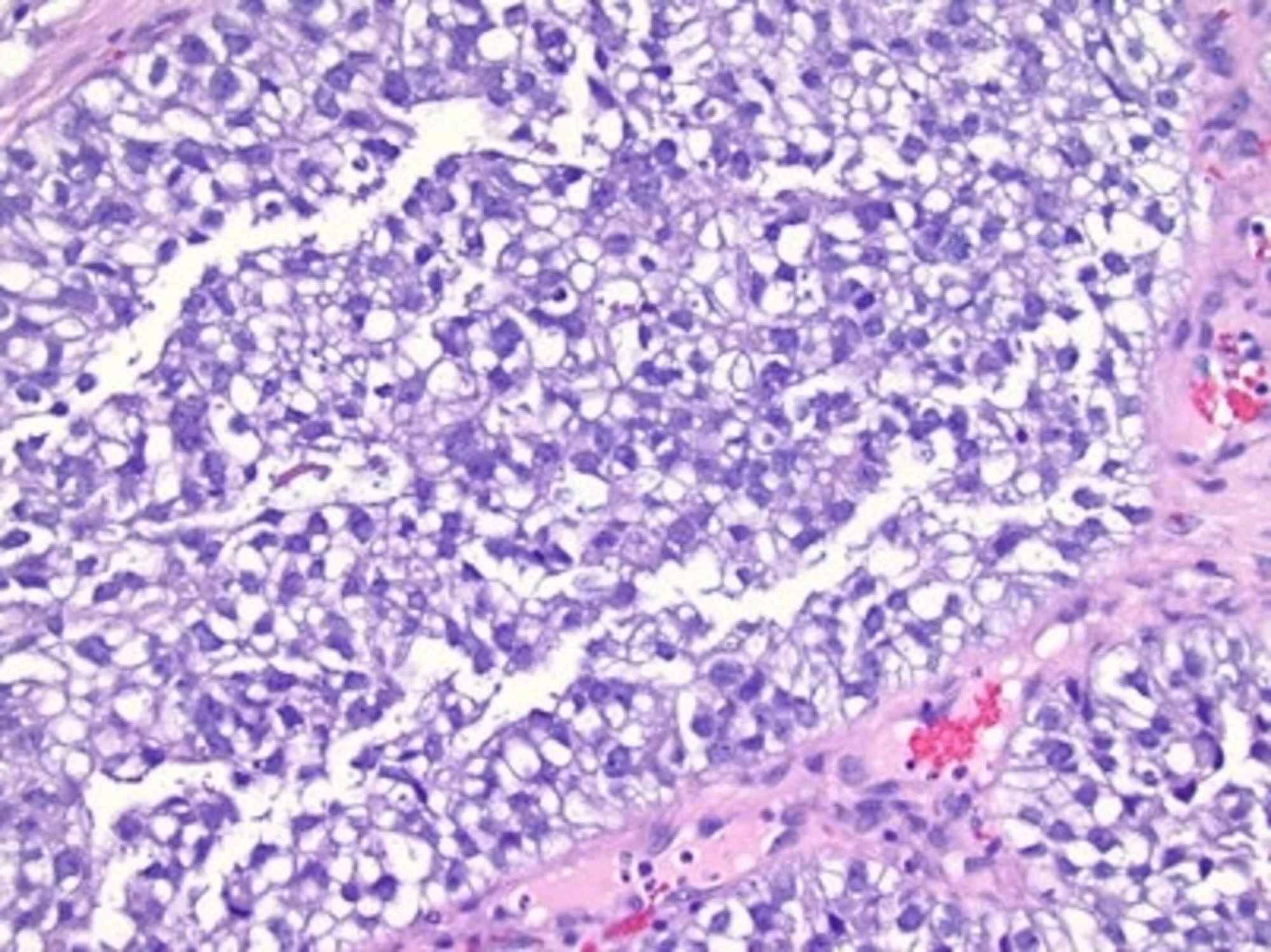 Cureus A Rare Case of Clear Cell Adenocarcinoma of the