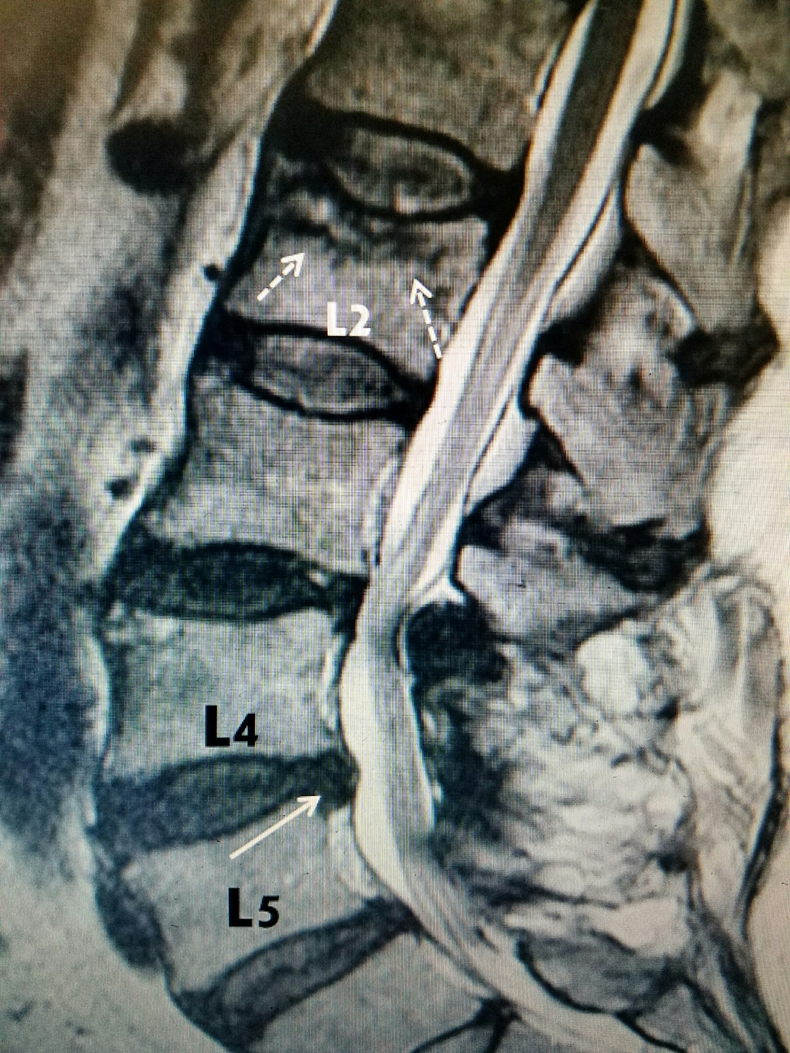 Cureus Delayed Recognition of Thoracic and Lumbar Vertebral