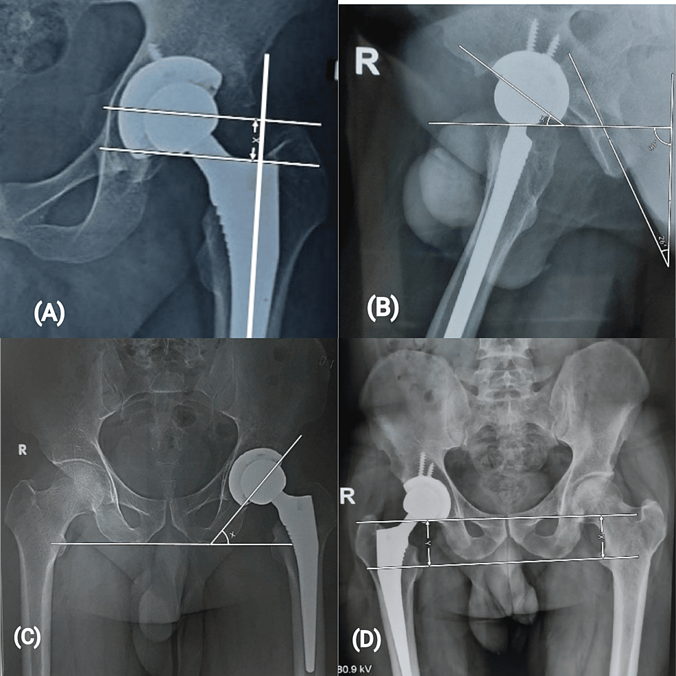 Total Hip Arthroplasty for Osteonecrosis of the Femoral Head: A Mid ...