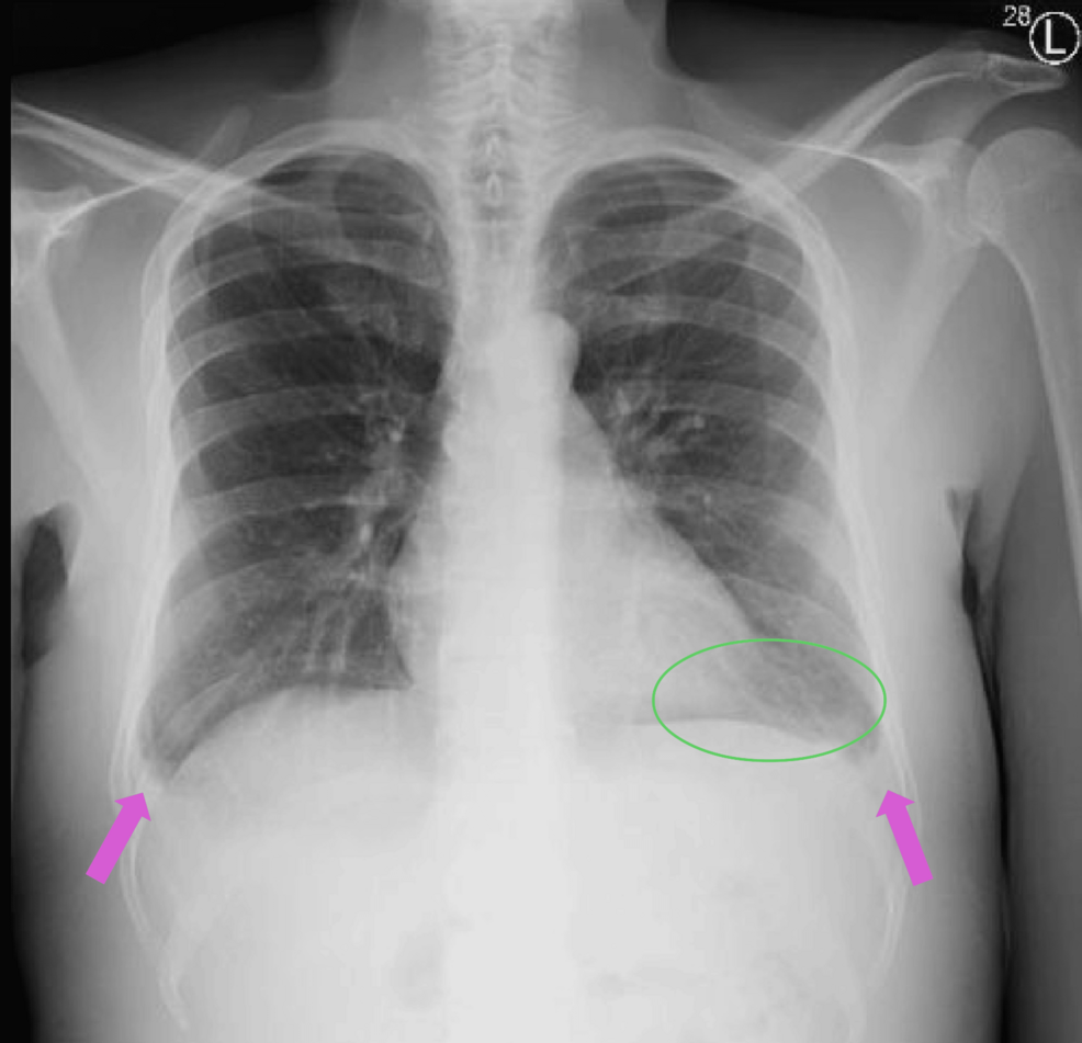 Chest-X-ray