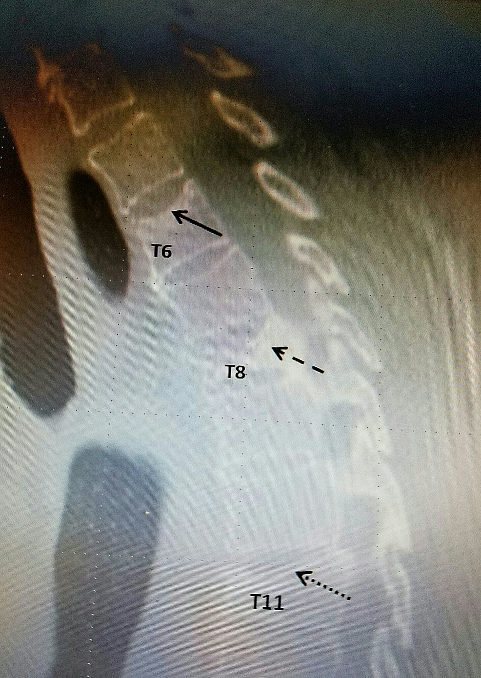 old t8 compression fracture treatment