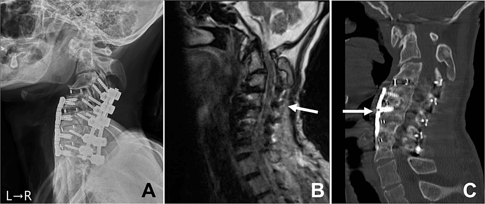 Severe Cervical Myelopathy In A Patient With Intellectual Disability Successfully Managed With 9617