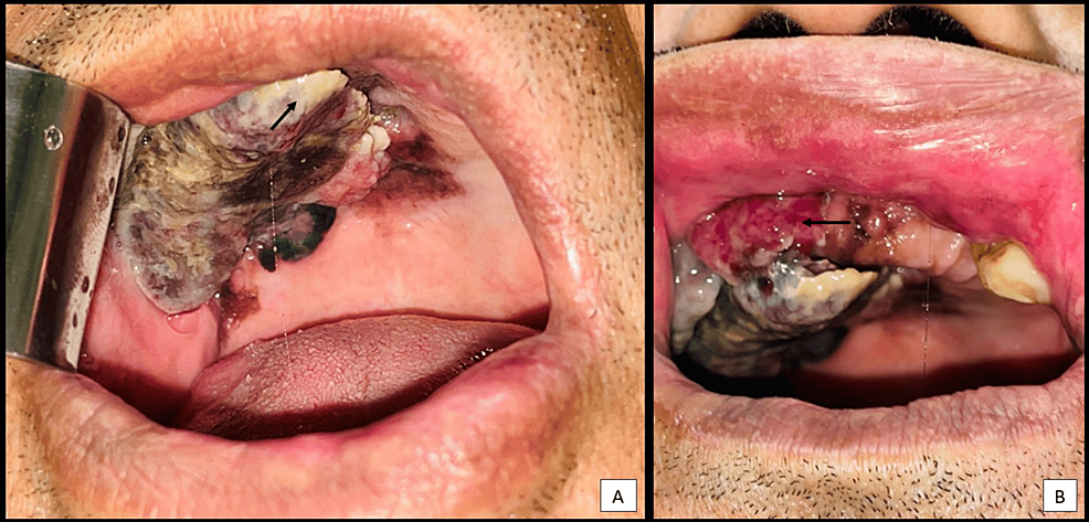 melanotic macule inside cheek Unveiling Oral Malignant Melanoma: Clinicopathological Details of a Case