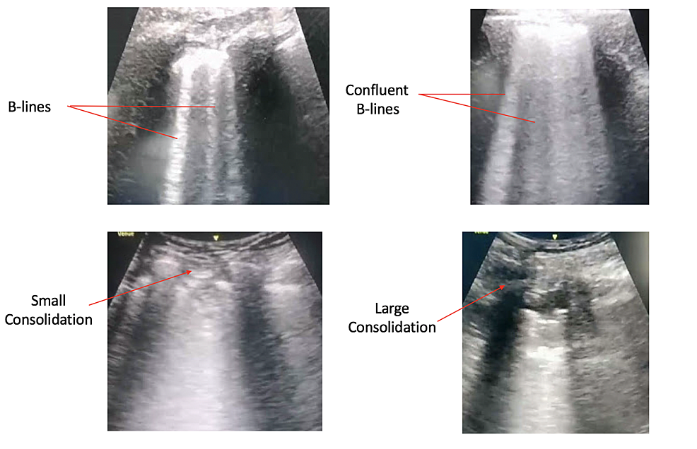 Lung-ultrasound-findings-in-patients-with-COVID-19