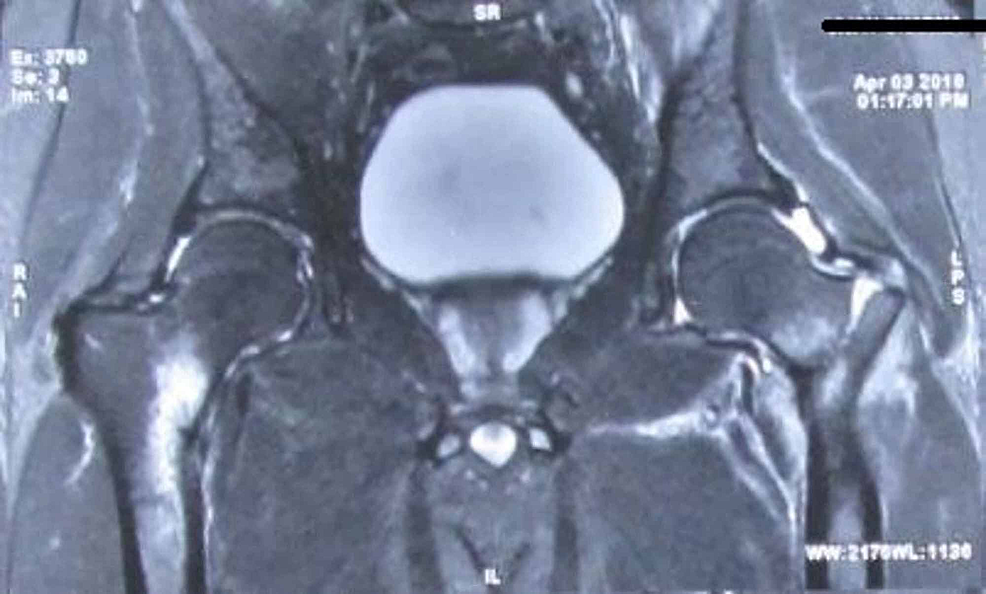 Cureus Stress Fracture of Bilateral Neck of Femur in a Healthy Non