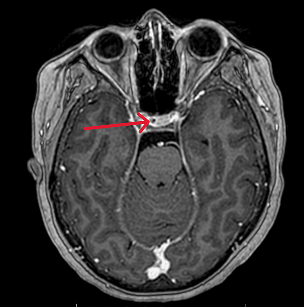 Axial-view-of-a-T1-MRI-with-contrast-showing-a-sellar-lesion