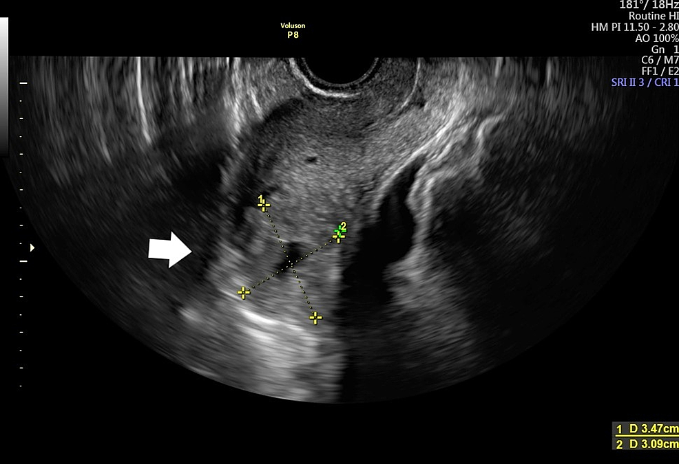 Cureus Interstitial Pregnancy Case Report of Atypical Ectopic Pregnancy
