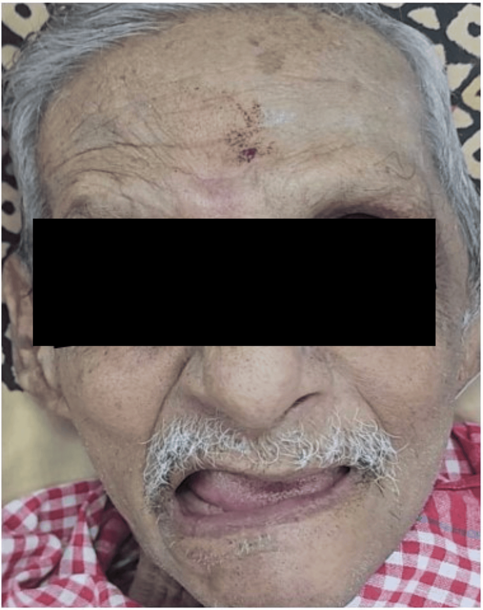 Understanding the Impact of Skull Base Osteomyelitis: A Retrospective  Analysis of 14 Cases | Cureus