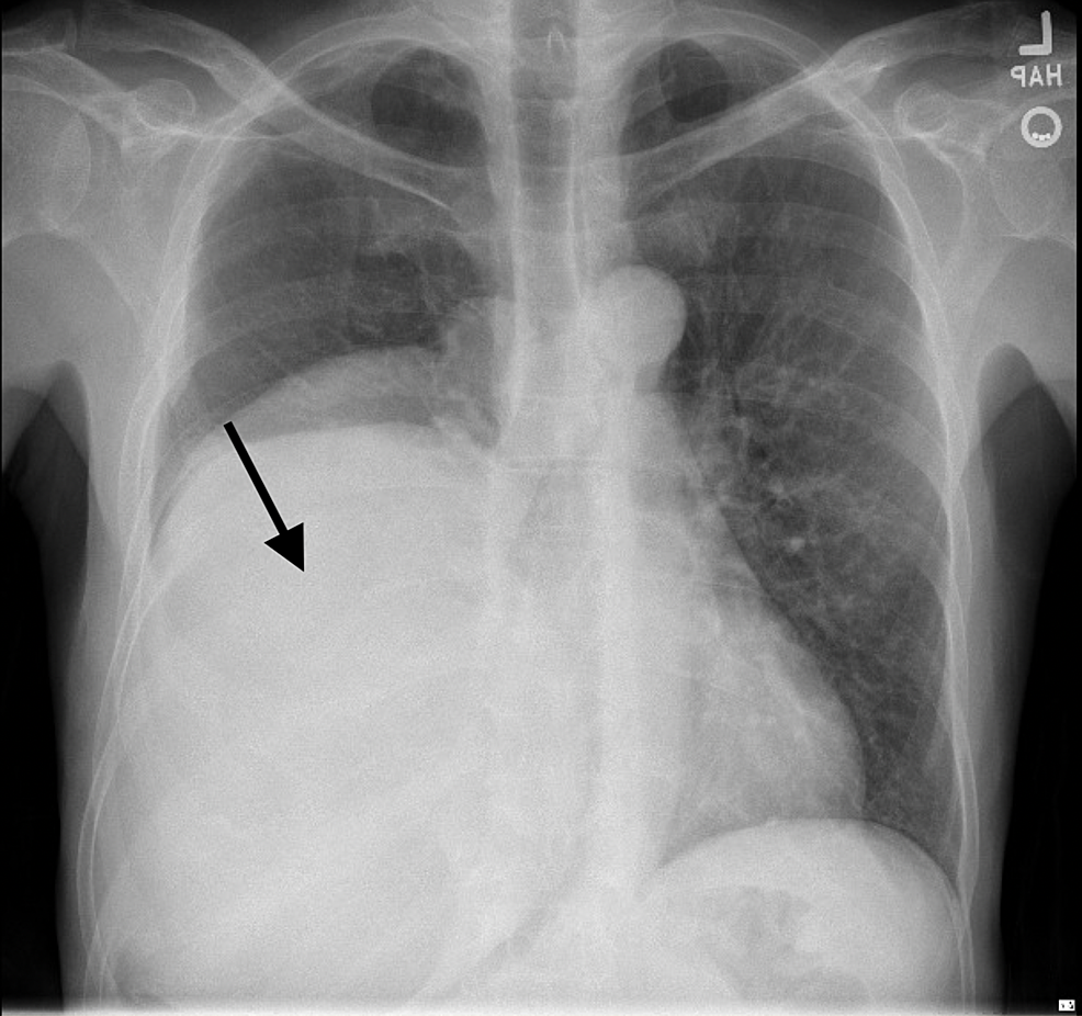 Chest-X-ray-showing-right-lower-lung-diffuse-opacity/mass-(arrow).-The-opacity-displaces-the-heart-posteriorly,-extends-inferiorly-below-the-field-of-view.-The-opacity-obscures-the-right-heart-border-and-right-hemidiaphragm.