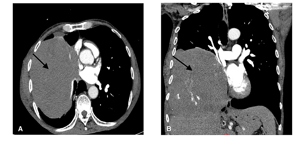 (A)-Cross-sectional-image-of-CT-chest-demonstrating-14-x-16-x-18-cm-heterogenous-right-lung/thoracic-mass-(arrow)-arising-from-right-hilum/middle-mediastinum-or-right-hemidiaphragm.-(B)-Coronal-CT-scan-showing-right-lung-mass-(arrow).