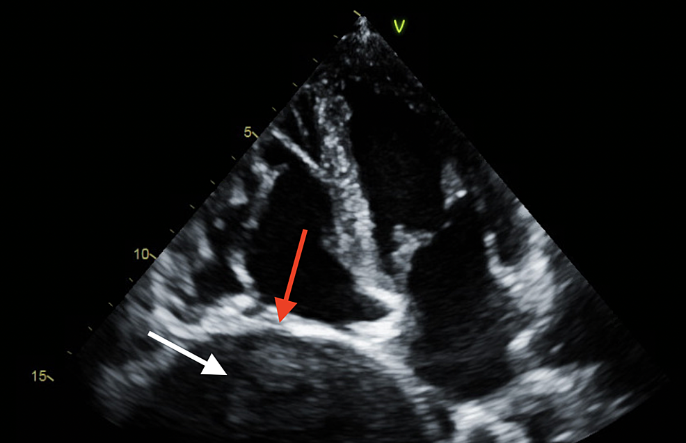 Transthoracic-echocardiogram-showing-lung-mass-(white-arrow)-compressing-the-right-atrial-cavity-(red-arrow).