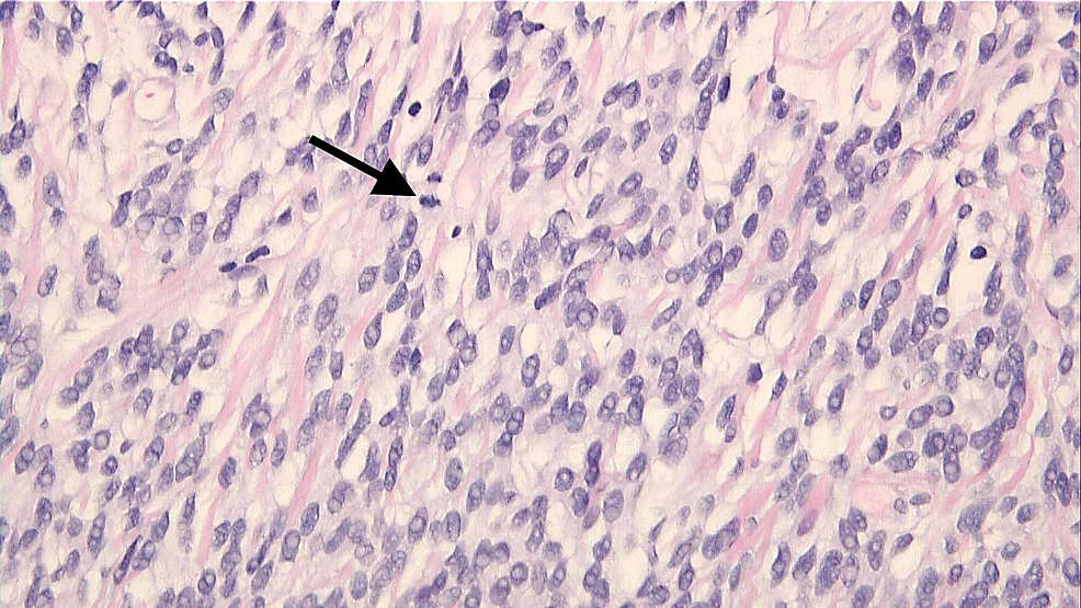 Histochemical-analysis-showed-a-spindle-cell-lesion-composed-of-sheets-of-spindle-cells-with-oval-or-elongated-nuclei-separated-by-collagen.-Focal-areas-with-mitotic-figures-up-to-3-per-10-HPF-were-identified-(arrow).