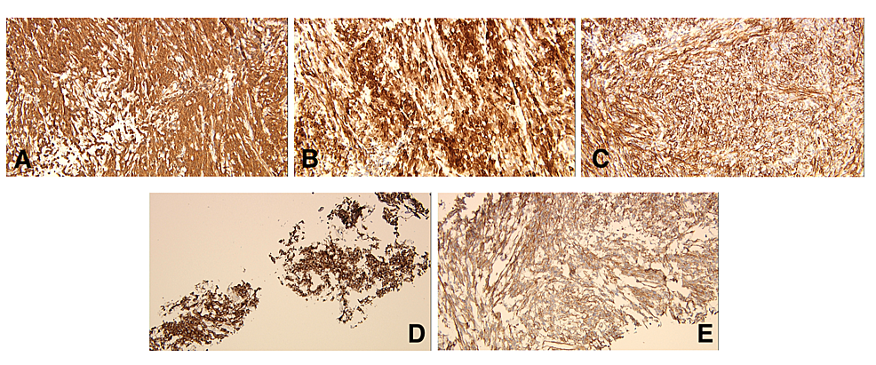 Immunohistochemistry-showing-positive-stains-for-(A)-Vimentin-(B)-Desmin-(C)-CD34-(D)-BCL-2-(E)-CD99.