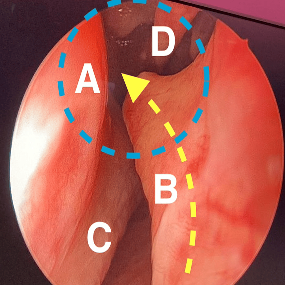 Endoscopic-view-of-the-right-side-nasal-cavity.