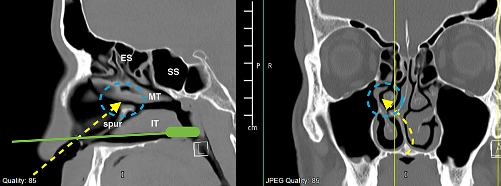 CT-scan-sinus.-(Left)-Sagittal-cut.-(Right)-Coronal-cut.