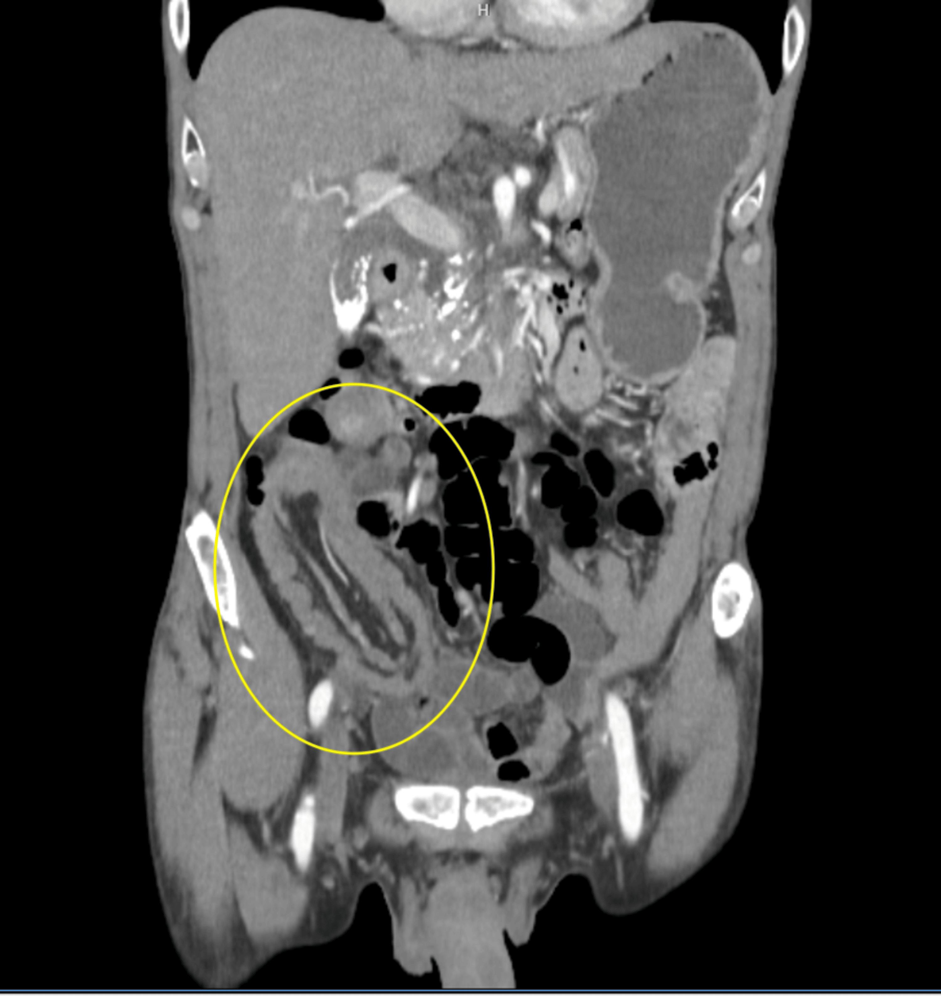 Intercepting the Intussusception: A Rare Case of Adult Intussusception ...