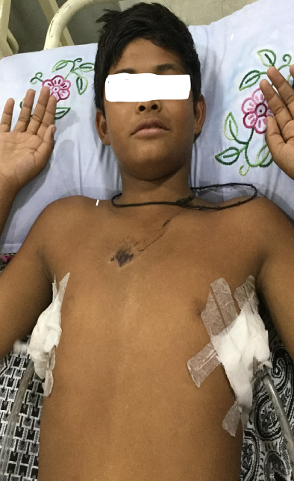 Chest-tubes-and-bruise-on-the-chest