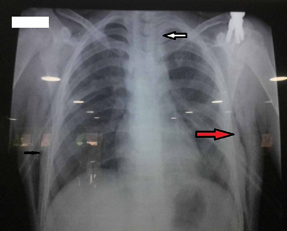 Chest-X-ray-posteroanterior-view-showing-gas-in-the-mediastinum-(white-arrow)-and-subcutaneous-emphysema-(red-arrow)