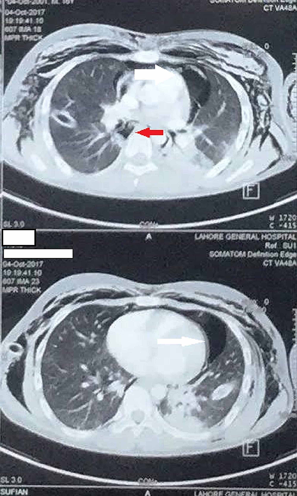 HRCT-of-the-chest-showing-pneumothorax-(white-arrow)-and-pneumomediastinum-(red-arrow)
